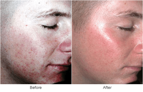 Acne Scar Treatment in St. Louis: Before & After