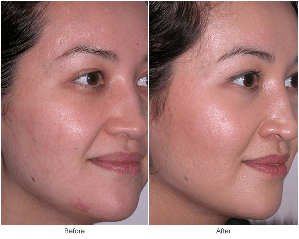 Acne Scar Treatment: Microdermabrasion & Skin Rejuvenation