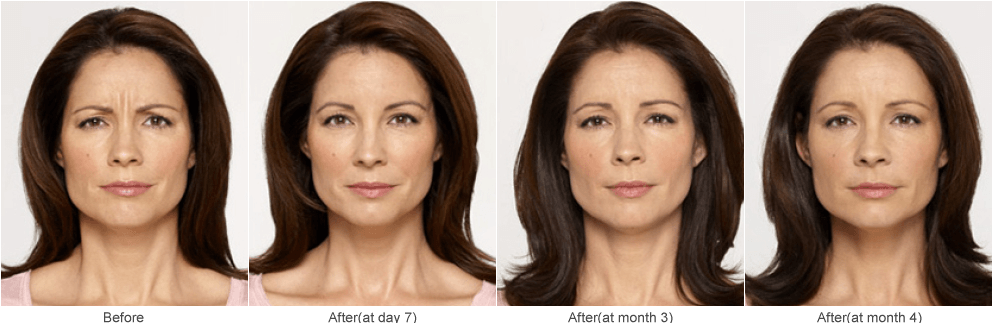 Botox Injections & Cosmetic Skincare Treatments in St. Louis