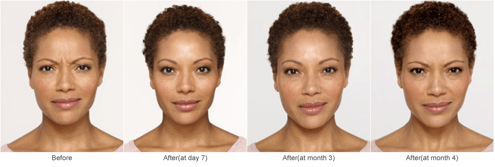 Botox Injections: Before & After Photos