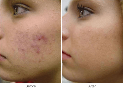 Chemical Peel & Cosmetic Skin Rejuvenation Treatments in St. Louis