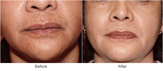 Chemical Peel: Before & After