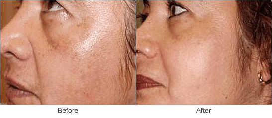Chemical Peel Treatments & Cosmetic Skin Rejuvenation in St. Louis