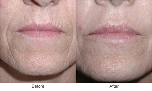 Skin Resurfacing & Facial Rejuvenation Treatment Before & After