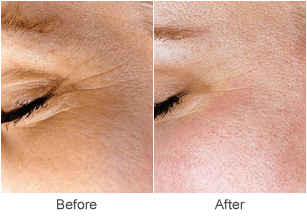 Co2 Skin Resurfacing & Rejuvenation Before & After