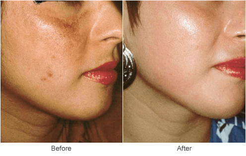 CO2 Skin Resurfacing Before & After Photos