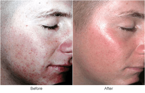 CO2 Skin Resurfacing & Cosmetic Skincare Treatment in St. Louis