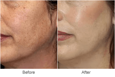 Skin Resurfacing & Facial Rejuvenation Treatments in St. Louis
