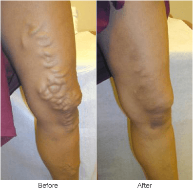 Endovenus Abalation Vein Treatment Before & After