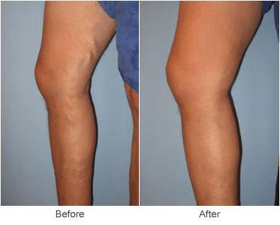 Endovenus Laser Abalation: Treatment for Varicose Veins in St. Louis