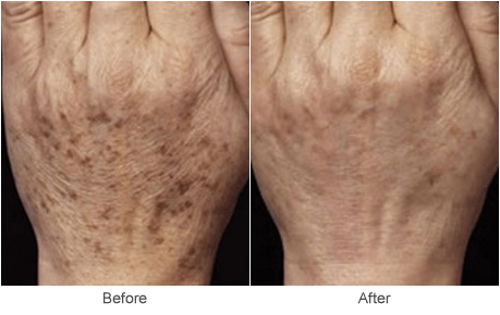 Hand Rejuevenation Treatment: Before & After Photo