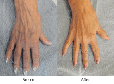 Hand Rejuevenation Treatment in St. Louis