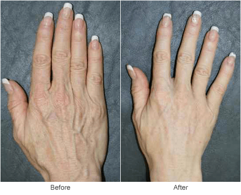 Before and After Hand Rejuevenation Treatment in St. Louis
