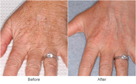 Hand Rejuevenation Treatment for Sun Spots