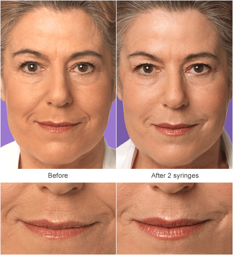 Juvenderm Filler Injection Before and After Photos