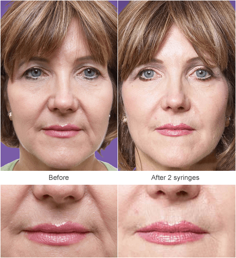 Juvenderm Filler Injection in St. Louis: Before and After Photos
