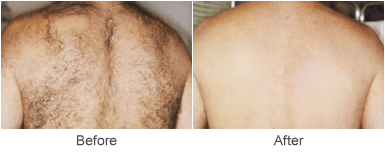 Laser Hair Removal in St. Louis: Before & After
