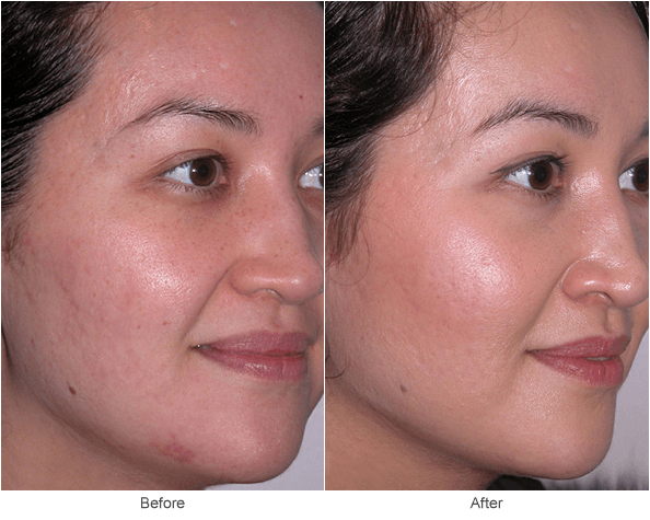 Microdermabrasion: Anti-Aging Skin Treatment Before & After