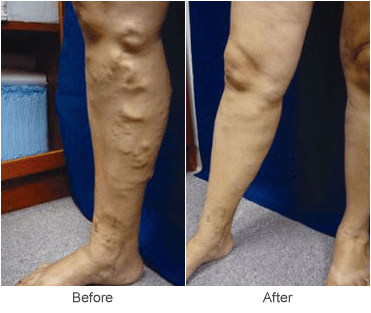 Varicose Vein Removal in St. Louis: Before & After Photo