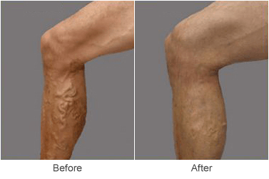 Varicose Vein Removal in St. Louis: Microincisional Phlebectomy