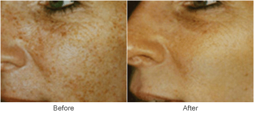 Photofacial Skin Treatments in St. Louis