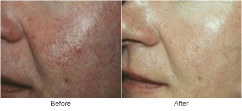>Photofacial Skin Treatment - Before & After Photo