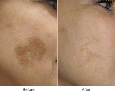 Sun Spot Removal & Skincare Treatment Before & After