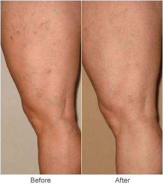 Sclerotherapy Vein Treatment: Before & After in St. Louis
