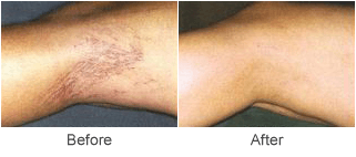 Sclerotherapy Vein Treatment Before & After Photo