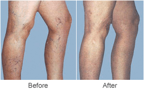 Varicose Vein Treatments & Sclerotherapy Treatment Before & After