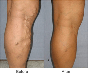 Varicose Vein Treatments: Before & After Photos