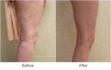 Sclerotherapy Varicose Vein Treatments in St. Louis