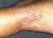 Treatment for Spider Veins in St. Louis