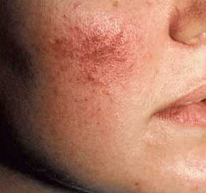 What are the main causes of facial spider veins?