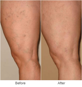 Spider Veins: Before & After Treatment