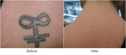 Laser Tattoo Removal Treatment in St. Louis | Before & After