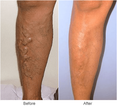 Varicose Vein Treatment: Sclerotherapy Before & After