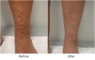 Varicose Vein Treatment: Ultrasound Guided Sclerotherapy