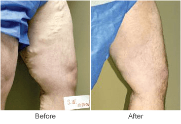 Varicose Vein Treatment: Before & After Photo