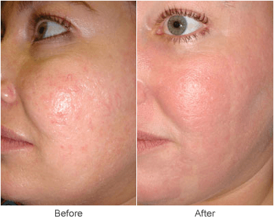 VeinGogh Treatments: Vein Treatment Before & After Photo