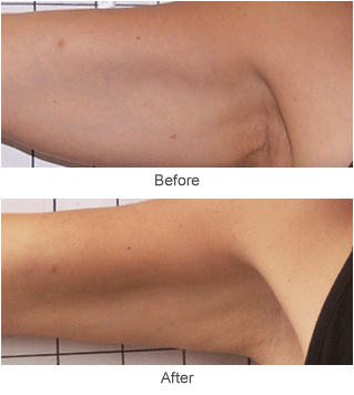 Skin Tightening Treatment Before & After