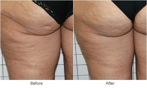 Cellulite Treatment in St. Louis: Before & After