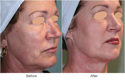 Venus Freeze Skin Tightening Before and After