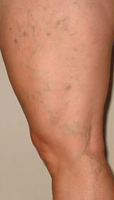 What Are Spider Veins & Treatments