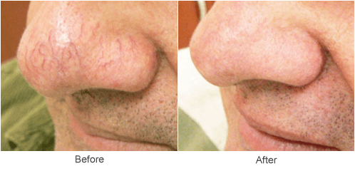Treatment for Spider Veins: Before & After Photo