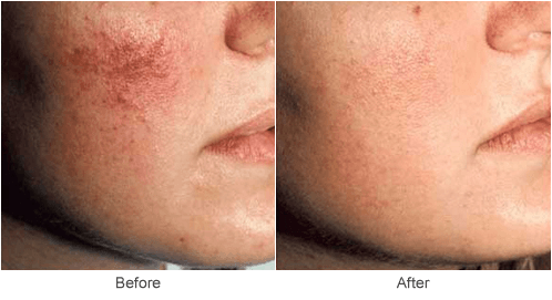 Before & After Laser Vein Treatment in St. Louis
