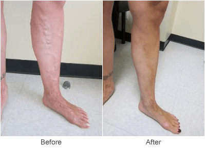 Varicose Vein Treatment Before & After Photo