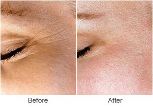 Wrinkle Treatments in St. Louis: Before & After