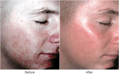 Acne Scar Treatment In St Louis Microdermabrasion Skin Rejuvenation Acne Scar Treatment In St Louis Microdermabrasion Skin Rejuvenation