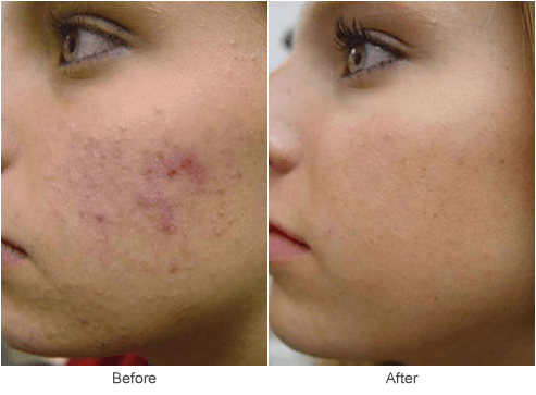 Acne Scar Treatment in St. Louis Microdermabrasion Skin